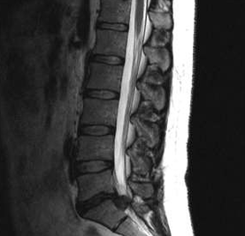 Az ágyéki osteochondrosis diagnosztikai lehetőségei