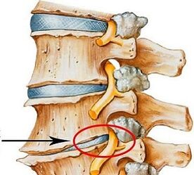 Miért van az ágyéki osteochondrosis