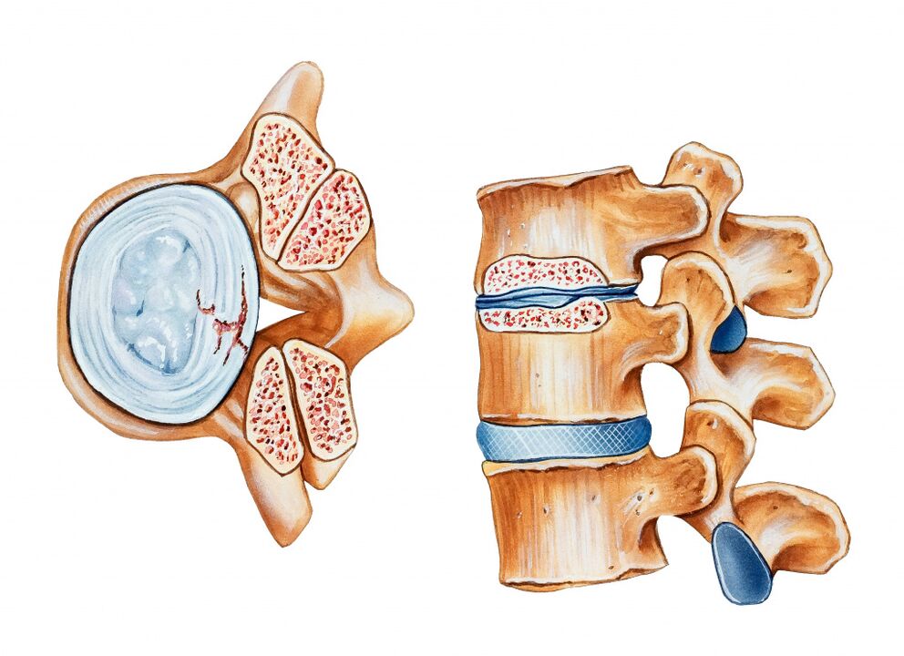 A nyaki régió osteochondrosis az intervertebrális korongok megsemmisítéséhez vezet