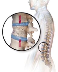 Az osteoporosis hátfájást provokál az alsó részben